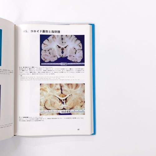 カラ－アトラス神経病理 第３版 組織病理カラーアトラス[Web付録付] 第3版 | 坂本 穆彦 |本